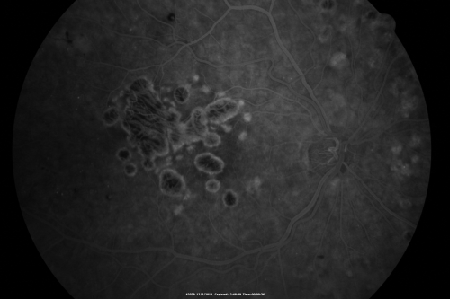 Diabetic Retinopathy - Foveal Laser Scar Right Eye
74-year-old woman has diabetic retinopathy in both eyes.  She has had focal laser in her right eye done elsewhere in the mid 90â€™s and unfortunately the laser was fairly close to the center and as time progressed she developed foveal atrophy around the scars.  She has noticed her vision declining since she was here last a year ago.  She does take Travatan in both eyes at night for glaucoma. 

VISUAL ACUITY:  OD 20/200,  OS 20/40. 
