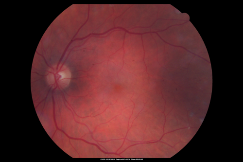 Diabetic Retinopathy - Foveal Laser Scar Right Eye
74-year-old woman has diabetic retinopathy in both eyes.  She has had focal laser in her right eye done elsewhere in the mid 90â€™s and unfortunately the laser was fairly close to the center and as time progressed she developed foveal atrophy around the scars.  She has noticed her vision declining since she was here last a year ago.  She does take Travatan in both eyes at night for glaucoma. 

VISUAL ACUITY:  OD 20/200,  OS 20/40. 
