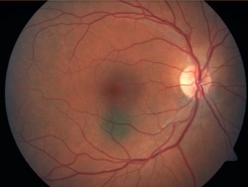 Choroidal Nevus in Macula 

