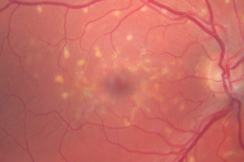Fundus Flavimaculatus - Asymptomatic - Color Photo
45 year old man was told to come in because of â€˜white spots on their retinaâ€™.

