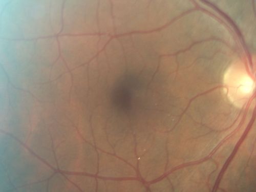 Crystalline retinopathy associated with chronic retinal detachment (Macular Crystals)
54-year-old man with an asymptomatic chronic inferotemporal retinal detachment (10 years old) OD 20/25, OS 20/30
