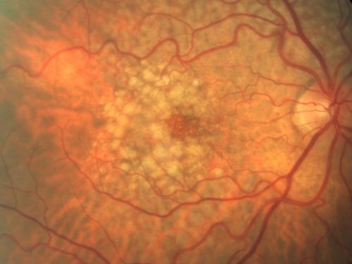 Reticular Macular Disease - Reticular Pseudodrusen and Soft Macular Drusen - 57 Year Old Woman
57-year-old woman was seen in the office on 2/22/2011.  She has macular drusen in both eyes.  I saw her back in 2006.  Since then she does notice slight increased distortion.  OD is 20/25, OS is 20/25
