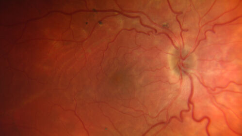 Nanophthalmous
Family history of poor eyes and bad vision since age 4
VA OD: Dsc20/80 
VA OS: Dsc20/125-2
