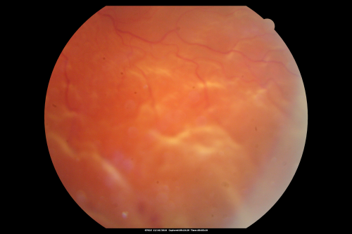 Pre-operative photograph - macula off, 3/200 retinal detachment
61-year-old man decreased vision left eye for 2 weeks.

VISUAL ACUITY:  OD 20/25,  OS 3/200
