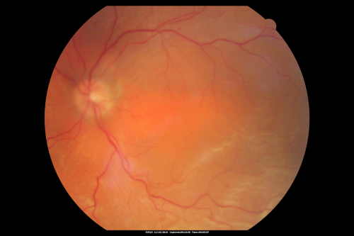 Pre-operative photograph - macula off, 3/200 retinal detachment
61-year-old man decreased vision left eye for 2 weeks.

VISUAL ACUITY:  OD 20/25,  OS 3/200
