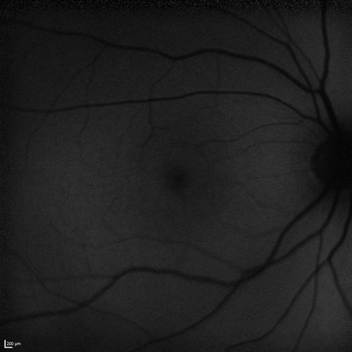 Dehydration Injury to Retina after Macula-On Retinal Detachment Repair - Also Subretinal Perfluoron
18 month ago he had a scleral buckle, vitrectomy, laser and gas for macula on retinal detachment. Since he notices blind spots in the center of the left eye/ He also notices a dense, inferior visual field defect. OD 20/20,  OS 20/50
