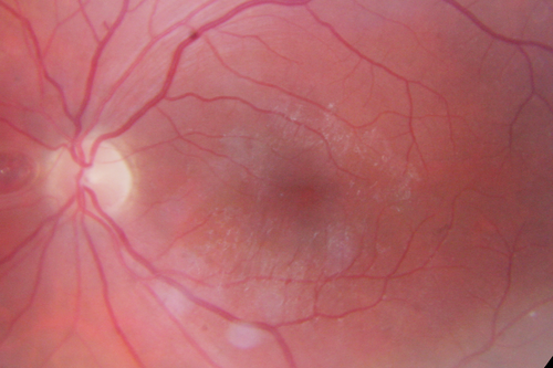 Dehydration Injury to Retina after Macula-On Retinal Detachment Repair - Also Subretinal Perfluoron
18 month ago he had a scleral buckle, vitrectomy, laser and gas for macula on retinal detachment. Since he notices blind spots in the center of the left eye/ He also notices a dense, inferior visual field defect. OD 20/20,  OS 20/50
