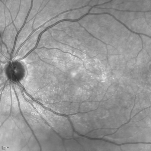 Dehydration Injury to Retina after Macula-On Retinal Detachment Repair - Also Subretinal Perfluoron
18 month ago he had a scleral buckle, vitrectomy, laser and gas for macula on retinal detachment. Since he notices blind spots in the center of the left eye/ He also notices a dense, inferior visual field defect. OD 20/20,  OS 20/50
