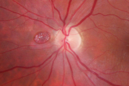 Dehydration Injury to Retina after Macula-On Retinal Detachment Repair - Also Subretinal Perfluoron
18 month ago he had a scleral buckle, vitrectomy, laser and gas for macula on retinal detachment. Since he notices blind spots in the center of the left eye/ He also notices a dense, inferior visual field defect. OD 20/20,  OS 20/50

