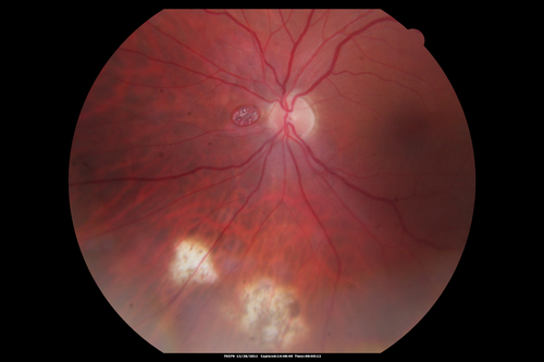 Dehydration Injury to Retina after Macula-On Retinal Detachment Repair - Also Subretinal Perfluoron
18 month ago he had a scleral buckle, vitrectomy, laser and gas for macula on retinal detachment. Since he notices blind spots in the center of the left eye/ He also notices a dense, inferior visual field defect. OD 20/20,  OS 20/50
