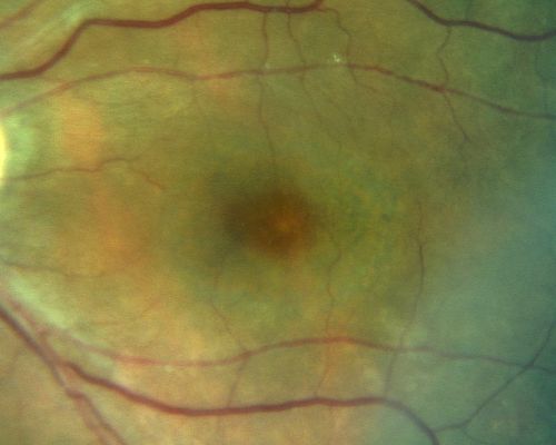 Plaquenil Toxicity with New Symptomatic Scotoma Left Eye
64-year-old female decreased vision OS over the past 2 months. She describes a blurred central scotoma. She has rheumatoid arthritis and is on Plaquenil 200 mg BID for 15 years. She does have yearly visual field tests done with last visual field test performed 3 years ago which was within normal limits OD 20/40-2 OS 20/40-1
