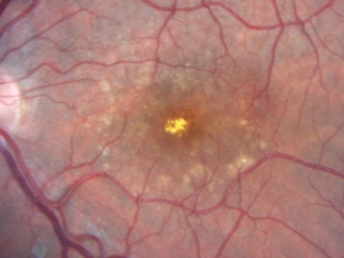 Adult Vitelliform Macular Dystrophy - Pattern Dystrophy
69-year-old woman sees a dark spot centrally.  When she looks at things she loses letters and numbers and is having more and more difficulty balancing her checkbook.  OD is 20/80, OS is 20/40
