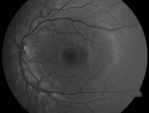 Pigmented Maculae - Mother and Daughter - Normal Visual Acuity
12-year-old  had a dilated macular exam and the macula look abnormal.  Interestingly, her mother, who is with her at this visit, was told about a year ago that her maculae are abnormal too.  Her motherâ€™s vision is fine.  In the family tree, there are no known retinal dystrophies.  They are both healthy.

VISUAL ACUITY:  Her vision is 20/20 in both eyes.
