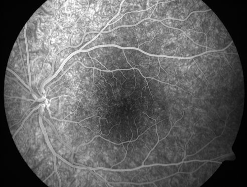 Pigmented Maculae - Mother and Daughter - Normal Visual Acuity
12-year-old  had a dilated macular exam and the macula look abnormal.  Interestingly, her mother, who is with her at this visit, was told about a year ago that her maculae are abnormal too.  Her motherâ€™s vision is fine.  In the family tree, there are no known retinal dystrophies.  They are both healthy.

VISUAL ACUITY:  Her vision is 20/20 in both eyes.

