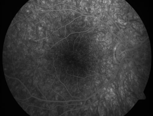Pigmented Maculae - Mother and Daughter - Normal Visual Acuity
12-year-old  had a dilated macular exam and the macula look abnormal.  Interestingly, her mother, who is with her at this visit, was told about a year ago that her maculae are abnormal too.  Her motherâ€™s vision is fine.  In the family tree, there are no known retinal dystrophies.  They are both healthy.

VISUAL ACUITY:  Her vision is 20/20 in both eyes.
