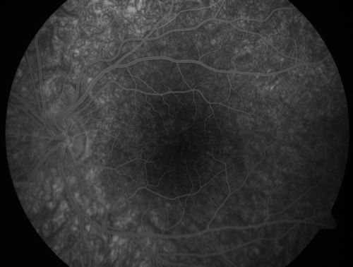 Pigmented Maculae - Mother and Daughter - Normal Visual Acuity
12-year-old  had a dilated macular exam and the macula look abnormal.  Interestingly, her mother, who is with her at this visit, was told about a year ago that her maculae are abnormal too.  Her motherâ€™s vision is fine.  In the family tree, there are no known retinal dystrophies.  They are both healthy.

VISUAL ACUITY:  Her vision is 20/20 in both eyes.
