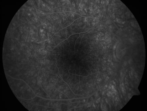 Pigmented Maculae - Mother and Daughter - Normal Visual Acuity
12-year-old  had a dilated macular exam and the macula look abnormal.  Interestingly, her mother, who is with her at this visit, was told about a year ago that her maculae are abnormal too.  Her motherâ€™s vision is fine.  In the family tree, there are no known retinal dystrophies.  They are both healthy.

VISUAL ACUITY:  Her vision is 20/20 in both eyes.
