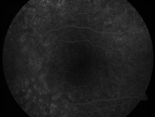 Pigmented Maculae - Mother and Daughter - Normal Visual Acuity
12-year-old  had a dilated macular exam and the macula look abnormal.  Interestingly, her mother, who is with her at this visit, was told about a year ago that her maculae are abnormal too.  Her motherâ€™s vision is fine.  In the family tree, there are no known retinal dystrophies.  They are both healthy.

VISUAL ACUITY:  Her vision is 20/20 in both eyes.

