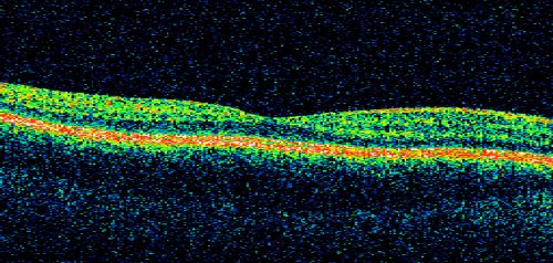 Pigmented Maculae - Mother and Daughter - Normal Visual Acuity
12-year-old  had a dilated macular exam and the macula look abnormal.  Interestingly, her mother, who is with her at this visit, was told about a year ago that her maculae are abnormal too.  Her motherâ€™s vision is fine.  In the family tree, there are no known retinal dystrophies.  They are both healthy.

VISUAL ACUITY:  Her vision is 20/20 in both eyes.
