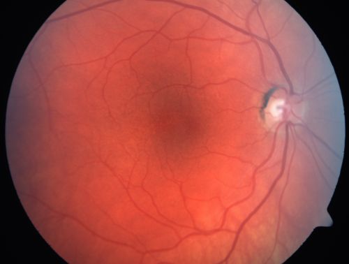 Pigmented Maculae - Mother and Daughter - Normal Visual Acuity
Mothers macular photos
