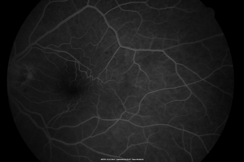 Macular Pucker 20/40 vision and recent cataract surgery
 73-year-old man distortion and vision loss since ECCE 6 months ago OS.  Patient taking anti-inflammatory drops. VISUAL ACUITY:  OD 20/30,  OS 20/40.
