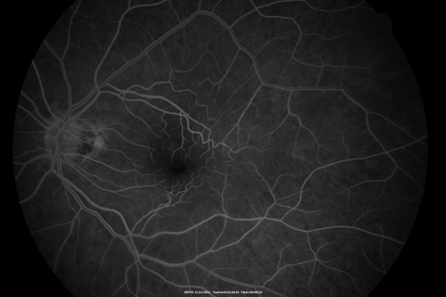 Macular Pucker 20/40 vision and recent cataract surgery
 73-year-old man distortion and vision loss since ECCE 6 months ago OS.  Patient taking anti-inflammatory drops. VISUAL ACUITY:  OD 20/30,  OS 20/40.
