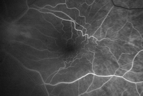 Macular Pucker 20/40 vision and recent cataract surgery
 73-year-old man distortion and vision loss since ECCE 6 months ago OS.  Patient taking anti-inflammatory drops. VISUAL ACUITY:  OD 20/30,  OS 20/40.
