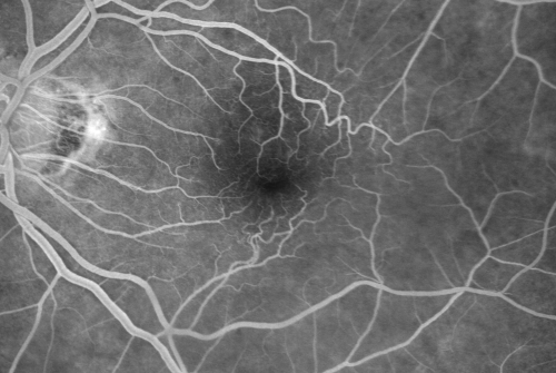 Macular Pucker 20/40 vision and recent cataract surgery
 73-year-old man distortion and vision loss since ECCE 6 months ago OS.  Patient taking anti-inflammatory drops. VISUAL ACUITY:  OD 20/30,  OS 20/40.
