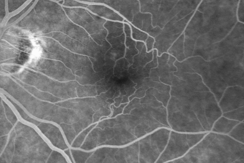 Macular Pucker 20/40 vision and recent cataract surgery
 73-year-old man distortion and vision loss since ECCE 6 months ago OS.  Patient taking anti-inflammatory drops. VISUAL ACUITY:  OD 20/30,  OS 20/40.
