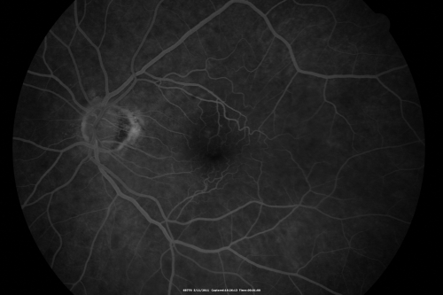 Macular Pucker 20/40 vision and recent cataract surgery
 73-year-old man distortion and vision loss since ECCE 6 months ago OS.  Patient taking anti-inflammatory drops. VISUAL ACUITY:  OD 20/30,  OS 20/40.
