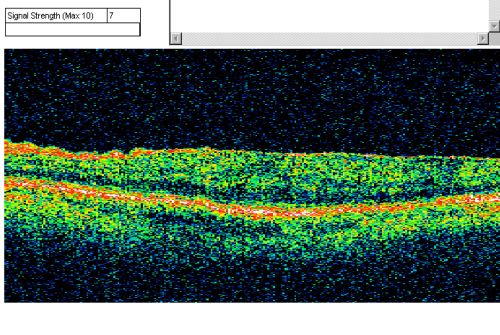 Macular Pucker 20/40 vision and recent cataract surgery
 73-year-old man distortion and vision loss since ECCE 6 months ago OS.  Patient taking anti-inflammatory drops. VISUAL ACUITY:  OD 20/30,  OS 20/40.
