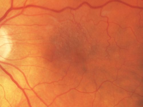 Macular Pucker 20/30 Good Vision 
64-year-old woman decreased vision in the left eye for about six months.  You saw a wrinkle on the eye and suggested she come in here for an evaluation.  She had radial keratotomy done 20 years ago.

VISUAL ACUITY: OD 20/25, OS 20/30
