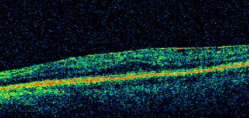 Macular Pucker 20/30 Good Vision 
64-year-old woman decreased vision in the left eye for about six months.  You saw a wrinkle on the eye and suggested she come in here for an evaluation.  She had radial keratotomy done 20 years ago.

VISUAL ACUITY: OD 20/25, OS 20/30
