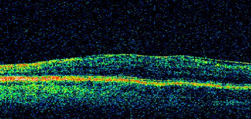 Macular Pucker 20/30 Good Vision 
64-year-old woman decreased vision in the left eye for about six months.  You saw a wrinkle on the eye and suggested she come in here for an evaluation.  She had radial keratotomy done 20 years ago.

VISUAL ACUITY: OD 20/25, OS 20/30
