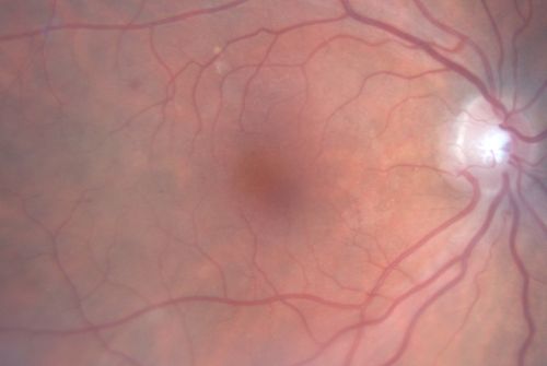 Macular Pucker - Diabetic - Severe  non-foveal Edema OS
74-year-old man has a macular pucker in the left eye and diabetic retinopathy.  
VISUAL ACUITY: Vision OD is 20/25, OS is 20/40.
