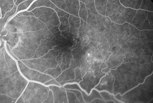 Macular Pucker - Diabetic - Severe  non-foveal Edema OS
74-year-old man has a macular pucker in the left eye and diabetic retinopathy.  
VISUAL ACUITY: Vision OD is 20/25, OS is 20/40.
