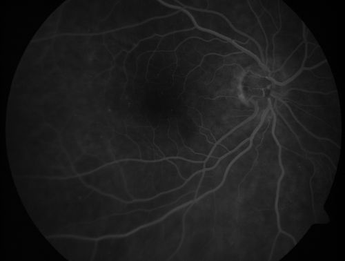 Macular Pucker - Diabetic - Severe  non-foveal Edema OS
74-year-old man has a macular pucker in the left eye and diabetic retinopathy.  
VISUAL ACUITY: Vision OD is 20/25, OS is 20/40.
