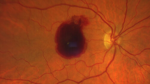 Retinal Arterial Macroaneurysm with pre-retinal hemorrhage
72 year old female who takes Xarelto had sudden vision loss while moving heavy furniture.  VA was 20/200.  The lesion has preretinal blood but later rebled with subretinal blood, was lasered and the final vision was not very good but the patient was lost to follow-up at 3 months
