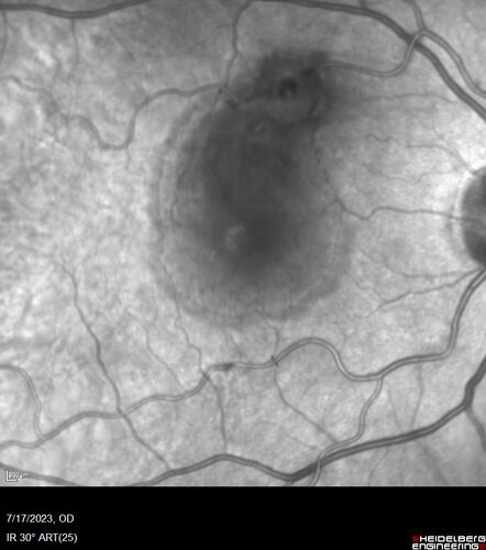 Retinal Arterial Macroaneurysm with pre-retinal hemorrhage
72 year old female who takes Xarelto had sudden vision loss while moving heavy furniture.  VA was 20/200.  The lesion has preretinal blood but later rebled with subretinal blood, was lasered and the final vision was not very good but the patient was lost to follow-up at 3 months
