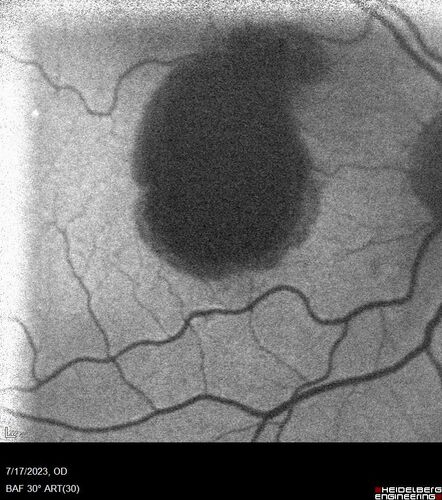 Retinal Arterial Macroaneurysm with pre-retinal hemorrhage
72 year old female who takes Xarelto had sudden vision loss while moving heavy furniture.  VA was 20/200.  The lesion has preretinal blood but later rebled with subretinal blood, was lasered and the final vision was not very good but the patient was lost to follow-up at 3 months
