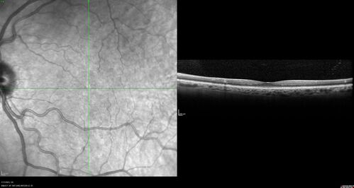 Retinal Arterial Macroaneurysm with pre-retinal hemorrhage
72 year old female who takes Xarelto had sudden vision loss while moving heavy furniture.  VA was 20/200.  The lesion has preretinal blood but later rebled with subretinal blood, was lasered and the final vision was not very good but the patient was lost to follow-up at 3 months
