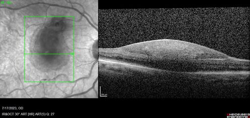 Retinal Arterial Macroaneurysm with pre-retinal hemorrhage
72 year old female who takes Xarelto had sudden vision loss while moving heavy furniture.  VA was 20/200.  The lesion has preretinal blood but later rebled with subretinal blood, was lasered and the final vision was not very good but the patient was lost to follow-up at 3 months
