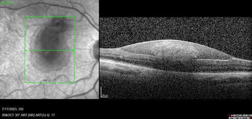 Retinal Arterial Macroaneurysm with pre-retinal hemorrhage
72 year old female who takes Xarelto had sudden vision loss while moving heavy furniture.  VA was 20/200.  The lesion has preretinal blood but later rebled with subretinal blood, was lasered and the final vision was not very good but the patient was lost to follow-up at 3 months
