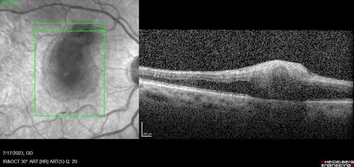 Retinal Arterial Macroaneurysm with pre-retinal hemorrhage
72 year old female who takes Xarelto had sudden vision loss while moving heavy furniture.  VA was 20/200.  The lesion has preretinal blood but later rebled with subretinal blood, was lasered and the final vision was not very good but the patient was lost to follow-up at 3 months
