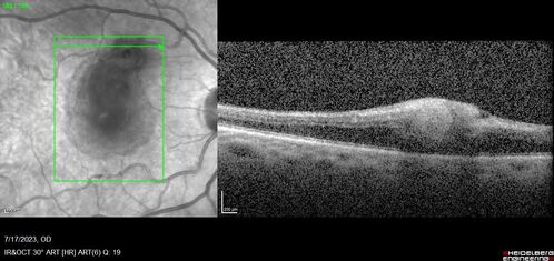 Retinal Arterial Macroaneurysm with pre-retinal hemorrhage
72 year old female who takes Xarelto had sudden vision loss while moving heavy furniture.  VA was 20/200.  The lesion has preretinal blood but later rebled with subretinal blood, was lasered and the final vision was not very good but the patient was lost to follow-up at 3 months
