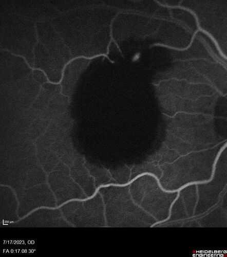 Retinal Arterial Macroaneurysm with pre-retinal hemorrhage
72 year old female who takes Xarelto had sudden vision loss while moving heavy furniture.  VA was 20/200.  The lesion has preretinal blood but later rebled with subretinal blood, was lasered and the final vision was not very good but the patient was lost to follow-up at 3 months
