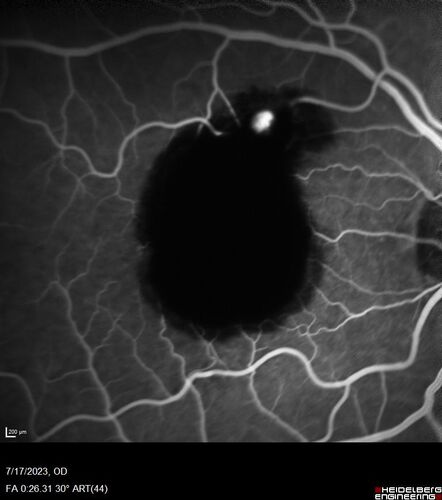 Retinal Arterial Macroaneurysm with pre-retinal hemorrhage
72 year old female who takes Xarelto had sudden vision loss while moving heavy furniture.  VA was 20/200.  The lesion has preretinal blood but later rebled with subretinal blood, was lasered and the final vision was not very good but the patient was lost to follow-up at 3 months
