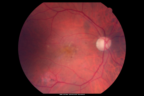 Macular Scar Left Eye from Age-Related Macular Degeneration
81-year-old woman has a macular scar in the left eye and then unfortunately developed a central retinal artery occlusion in the right eye  OD 20/100, OS 6/200.
