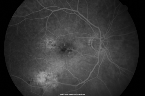 Macular Scar Left Eye from Age-Related Macular Degeneration
81-year-old woman has a macular scar in the left eye and then unfortunately developed a central retinal artery occlusion in the right eye  OD 20/100, OS 6/200.
