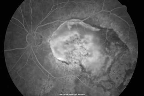 Macular Scar Left Eye from Age-Related Macular Degeneration
81-year-old woman has a macular scar in the left eye and then unfortunately developed a central retinal artery occlusion in the right eye  OD 20/100, OS 6/200.
